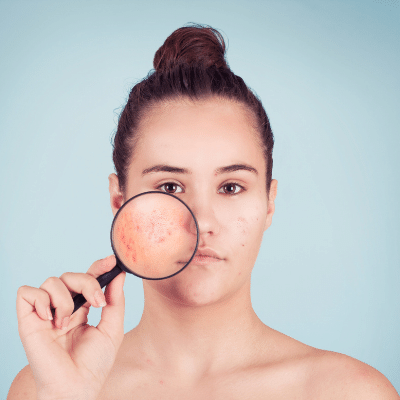 syndrome prémenstruel acné