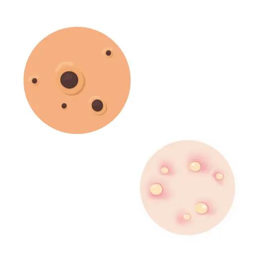 Acné rétentionnelle