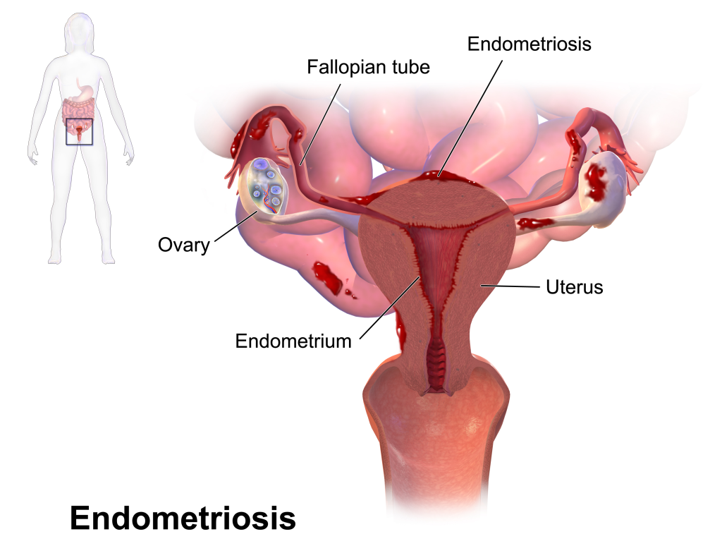 Lésions endométriose décodage biologique