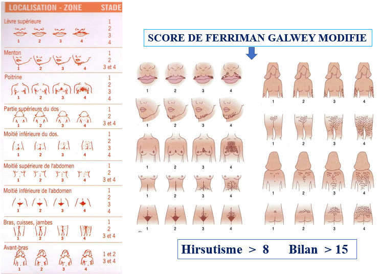 Score Ferriman et Gallwey