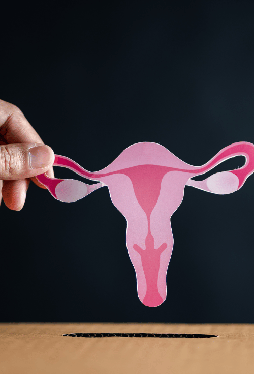 Le SOPK comme cause de l'hirsutisme féminin