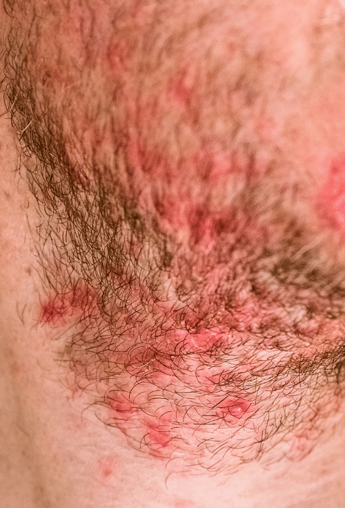 Poils menton barbe femme