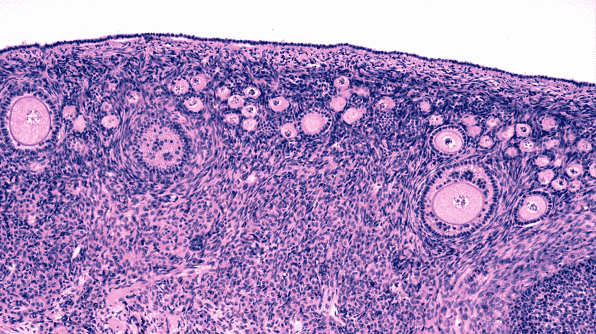 Insuffisance ovarienne prématurée IOP : cause, diagnostic, symptômes et traitements médicaux et naturels